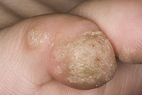 Plantar warts